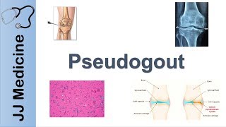 Pseudogout  Pathophysiology Symptoms and Treatment [upl. by Eicnahc]