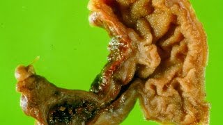 Meckels diverticulum  Pathology mini tutorial [upl. by Lowrie]