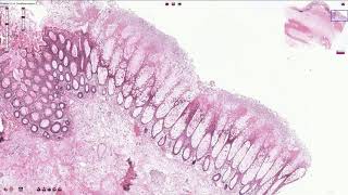 Pseudomembranous Colitis  Histopathology [upl. by Rostand]