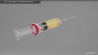 ACP  Autologous Conditioned Plasma [upl. by Erual]