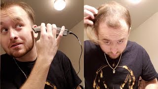 BALDING AT 20  Going Bald And Shaving My Head for good [upl. by Hardan]