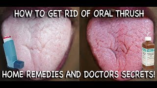 How to Treat Candida at Home Doctors Advice [upl. by Raffo553]