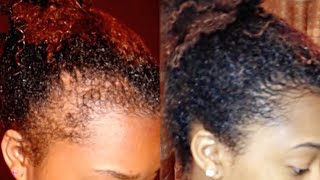 How to Regrow your Edges Bald Spots and Thinning Hair [upl. by Uyekawa]