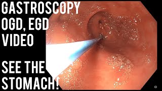 Gastroscopy  OGD  See inside the stomach [upl. by Llewen600]