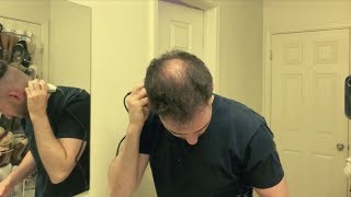 BALDING IN MY 20s  Shaving My Head And Embracing Going Bald LIVE [upl. by Vada]