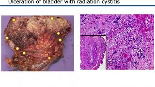 Painful Bladder Syndrome PBS  Interstitial Cystitis IC [upl. by Harry236]