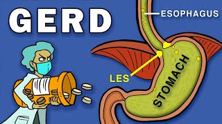 Gastroesophageal Reflux Disease GERD [upl. by Garry]