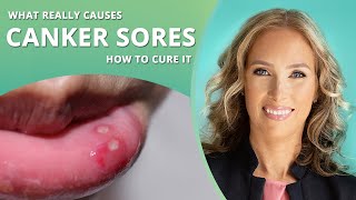 Canker Sores  How to Get Rid of Canker Sores  Dr J9 Live [upl. by Silsbye]