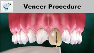 Dental Veneers Procedure Step by step [upl. by Yuille200]