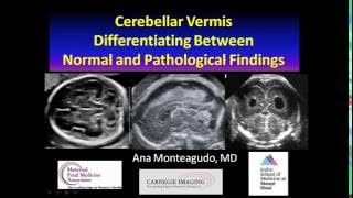 AIUM Webinar Cerebellar Vermis [upl. by Dlanor]