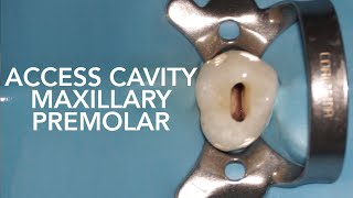 Pre Clinical Endodontic  Access Cavity of Maxillary Premolar [upl. by Berger]