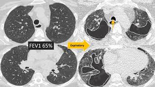 Understanding Bronchiolitis [upl. by Bonaparte832]