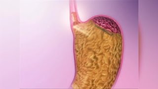 Acid Reflux Natural Remedies [upl. by Notled]