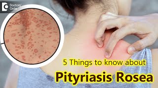 5 Things to know about Pityriasis Rosea  Pityriasis Rosea Rash  Dr Divya SharmaDoctors Circle [upl. by Notak752]