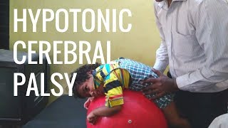 What is cerebral palsy [upl. by Ranice112]