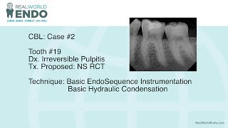 CBL 2 Basic Molar Root Canal Therapy 19 by RealWorldEndo [upl. by Edals605]