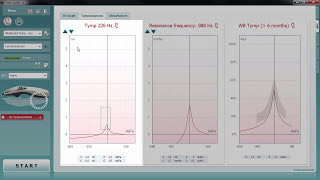 Wideband Tympanometry WBT Tympanograms Tab [upl. by Lynea]