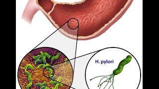 Helicobacter Pylori [upl. by Nyvlem931]