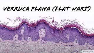 Verruca Plana Flat Wart under the microscope 5Minute Pathology Pearls [upl. by Keligot]