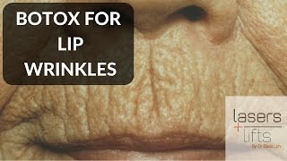 BOTOX for lip wrinkles [upl. by Soloman]