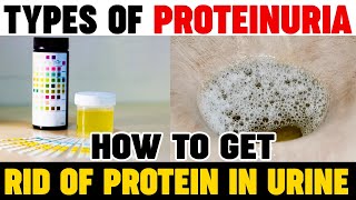 Types Of Proteinuria  How To Get Rid Of Protein In Urine  Kidney Expert  Karma Ayurveda Reviews [upl. by Eissirk]