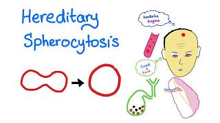 Hereditary Spherocytosis HS  Red Blood Cell Disorders  Hematology [upl. by Deb]