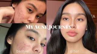 How I Cleared my Acne somehow PHILIPPINES  Lj Torres [upl. by Romola]