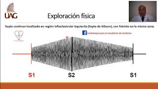 Persistencia del conducto arterioso [upl. by Nosydam901]