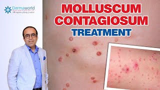 Molluscum Contagiosum Treatment  Dr Rohit Batra [upl. by Rabin]