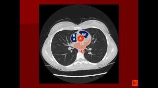 Normal Chest CT with labels [upl. by Zoes631]