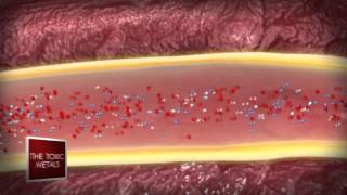 Benefits of EDTA Chelation Therapy Part325 04 2012 [upl. by Sloatman]