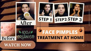 Face Pimples Treatment At Home  ACNE TREATMENT  Pimples Kese Hataye  shivammalik [upl. by Eelirem]