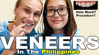 VENEERS PROCEDURE and COST in the Philippines 2021 🇵🇭 Celebrity Filipino Dentist [upl. by Nnaillij580]