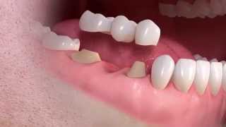 Straumann  Conventional 3unit bridge treatment [upl. by Odlamur187]