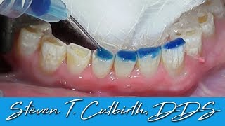 Bonding Worn Anterior Teeth  Dental Minute with Dr Steven T Cutbirth DDS [upl. by Dougal503]