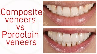 Composite veneers vs Porcelain veneers [upl. by Acire482]