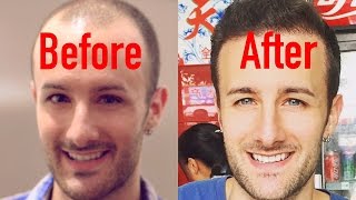 Hair Transplant Surgery in Los Angeles CA Best FUE Hair Restoration in LA Beverly Hills SF [upl. by Lurleen]