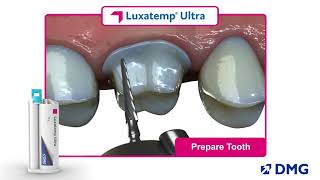 Luxatemp Ultra Rated 1 in Flexural Strength [upl. by Philbin]