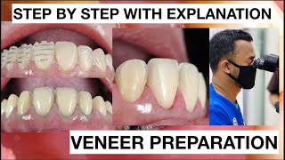 Step by Step Minimally Invasive Veneers Preparation  General Dentist Griya RR [upl. by Naivad]