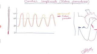 Cardiac Tamponade and Pulsus paradoxus [upl. by Haag]