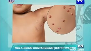 UNTV Life What causes water warts in adults and kids [upl. by Aisilef]