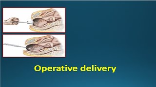 OPERATIVE DELIVERY  Instrumental deliveries Vacuum amp Forceps [upl. by Lorinda110]