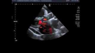 Atrial Septal Defect [upl. by Arturo]