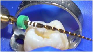 WaveOne Gold ® Technique  Dr Willy Pertot  Dentsply Sirona [upl. by Parshall406]