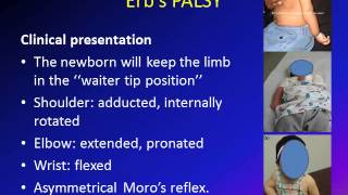 Cerebral Palsy Early Signs and Symtoms [upl. by Hamburger]