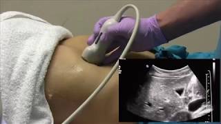 How to ultrasound the liver [upl. by Green]