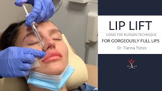 Lip Filler Lip Lift with the Russian Technique [upl. by Iak]