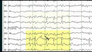 Focal EEG Abnormalities 1 [upl. by Emylee247]