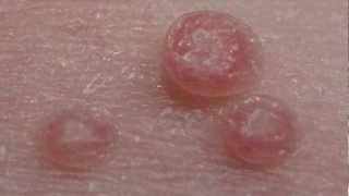 How to treat Molluscum Contagiosum [upl. by Roxie591]