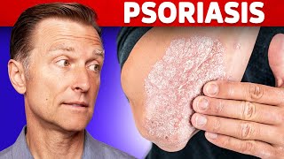 Psoriasis Treatment – The Best 3 Remedies for Psoriasis – DrBerg [upl. by Aseuqram]